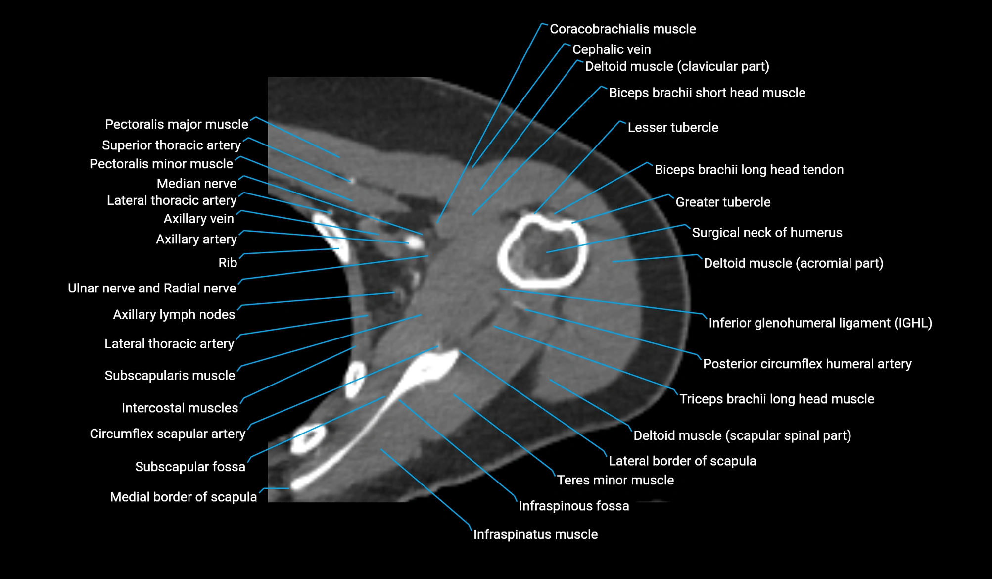 CT upper arm axial  cross sectional anatomy labelled radiology image -00116.webp